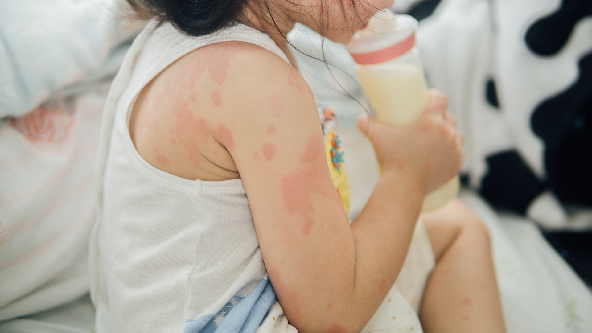 Managing allergies in childcare